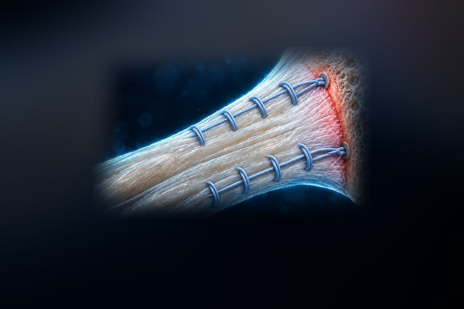Illustration of a repaired tendon and bone